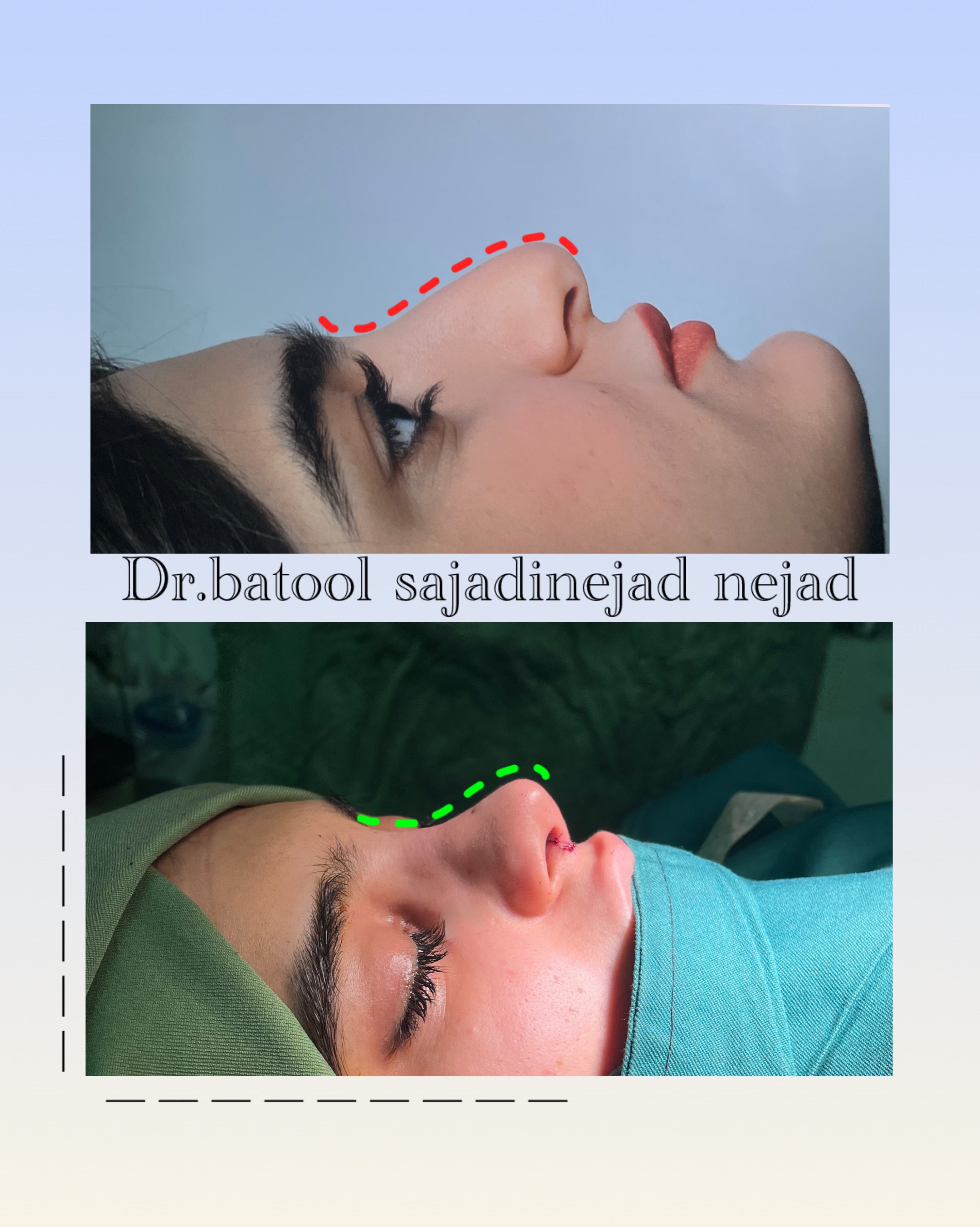نتایج جراحی بینی - قبل و بعد