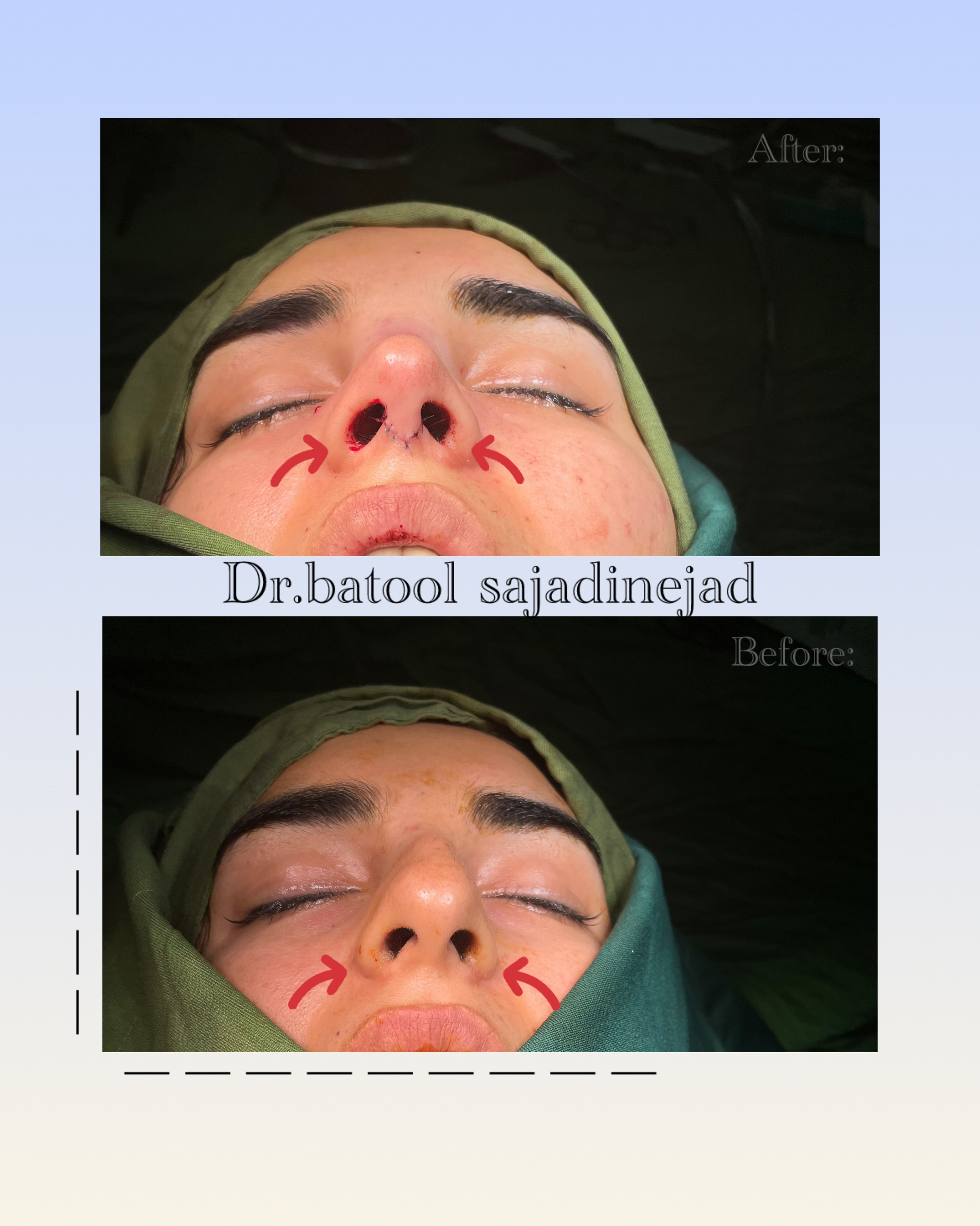نتایج جراحی بینی - قبل و بعد